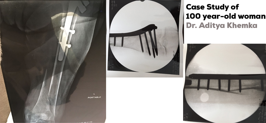 100 YEAR-OLD WOMAN SUCCESSFULLY OPERATED BY RENOWNED ORTHOPEDIC SURGEON