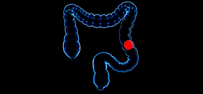 Colorectal Cancer: An emerging threat to life