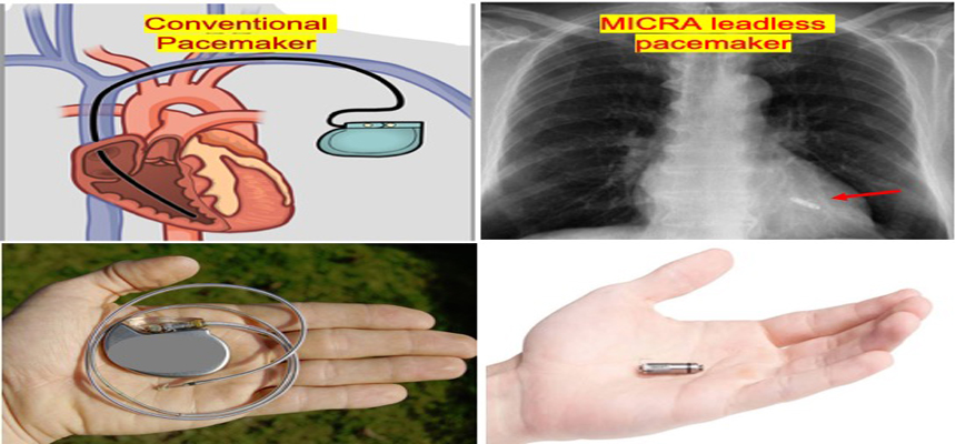 Worldâ€™s smallest and lightest leadless pacemaker MICRA implanted at Fortis Malar Hospital