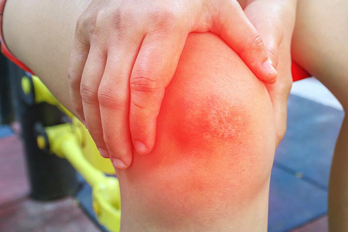 WHEN CELLULITIS ESCALATES TO SEPSIS - WHY IT IS IMPORTANT TO REACT BEFORE ITâ€™S TOO LATE