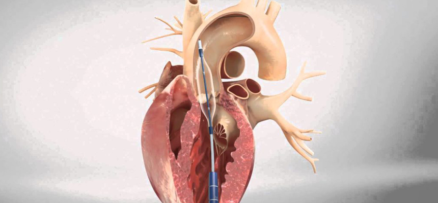 TAVR Is A New Lease of Life