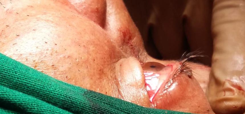 Kohinoor Hospital successfully removes 1.5 cm tumour from 47 year old man eye via nose