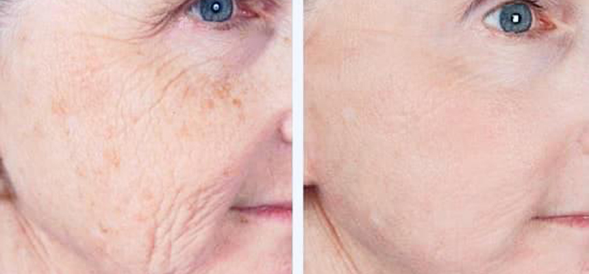 Get rid of Ageing through Non surgical Facelift