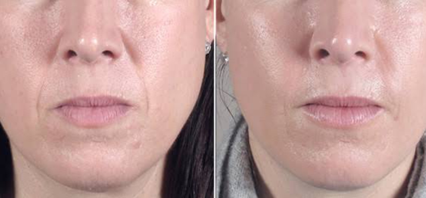 Everything about Fat Grafting