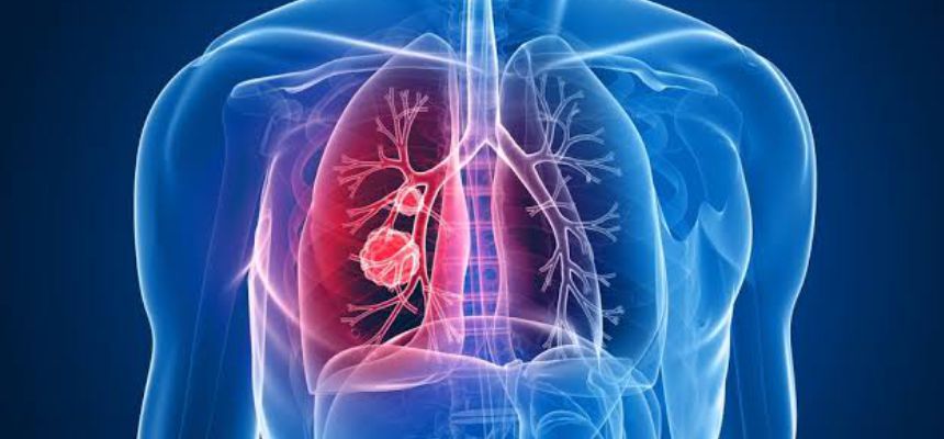 Symptoms, Causes, and Treatment of Lung Cancer 