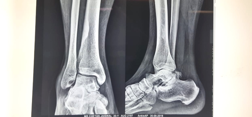 Wockhardt Hospital Mira Road Successfully Treated A 30 year old Man Battling Ankle Pain For 8 Years