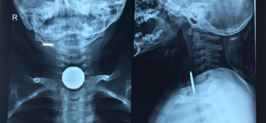 Wockhardt Hospital Successfully Pulled Out Foreign Bodies Lodged in Children During the Lockdown