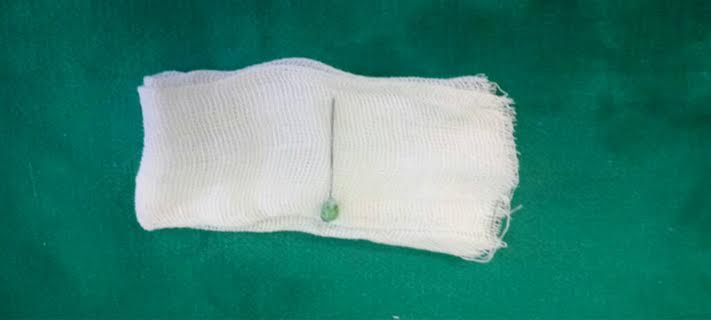 Hair pin removed from lung 