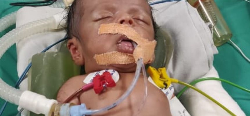 Wadia Hospital Performs A Life saving Complex Surgery On A Newborn Baby Boy From Ahmednagar
