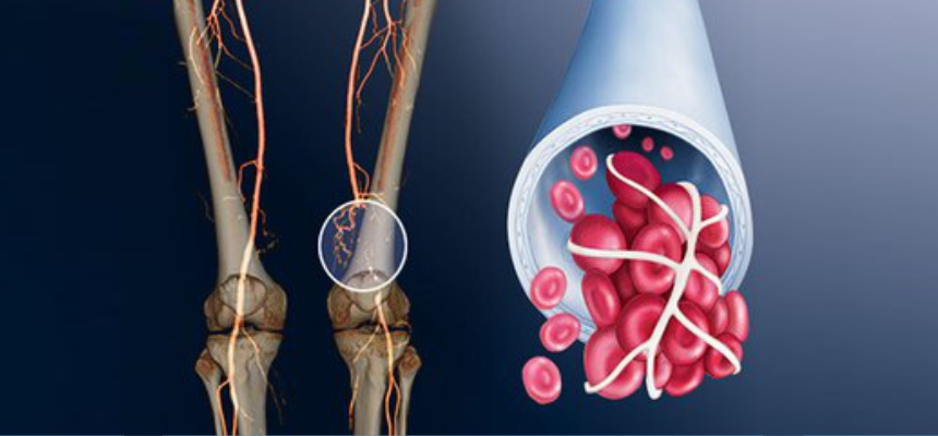CORRELATION OF COVID 19 AND LIFE THREATENING BLOOD CLOTS, IS IT THE REASON FOR FATALITY