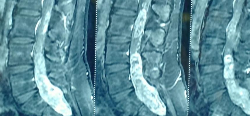 Doctors at Continental Hospitals remove a rare spinal tumour touching vital nerves to the legs and the bladder