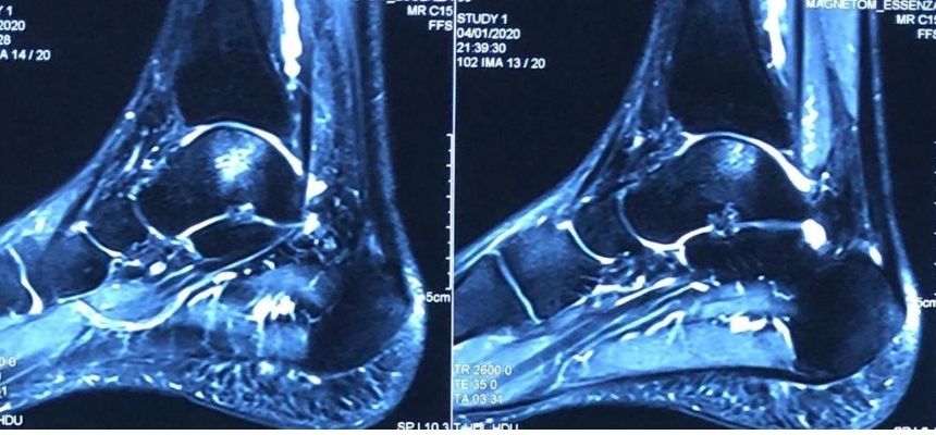A NOVEL TECHNIQUE TO REPAIR CARTILAGE DEFECTS Performed for the first time in South India at KIMS Hospitals, Hyderabad