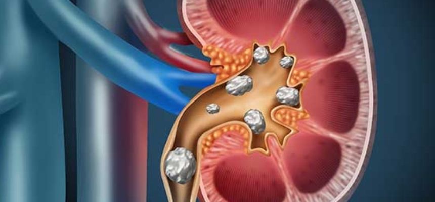 WHAT CAUSES KIDNEY STONES AND HOW TO TAKE CARE