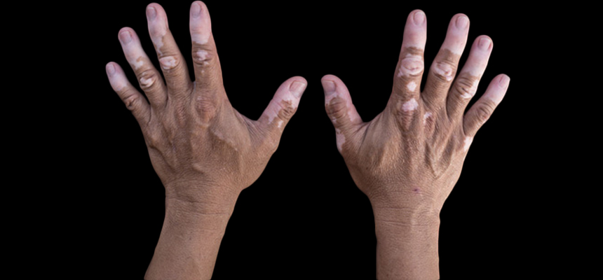 White Patches of Vitiligo are Not as Harmful as You Think