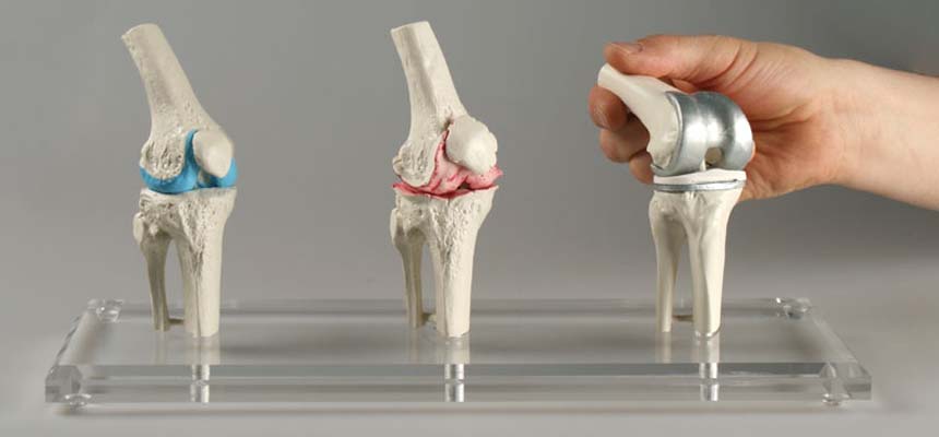 MTAL Wants Government To Re-Look Into Cap In Prices Of Knee Implants