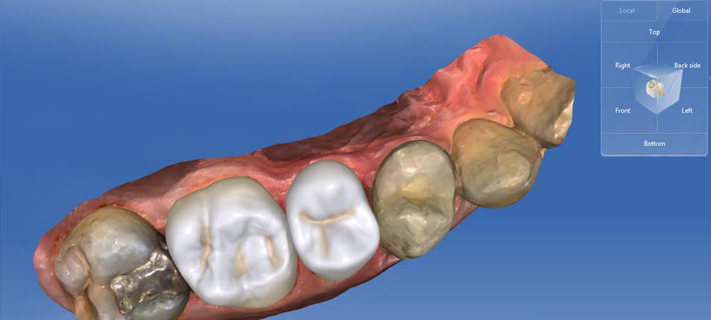Eledent Hospitals brings to Hyderabad, revolutionary CEREC TECHNOLOGY for the time-bound dental patient.