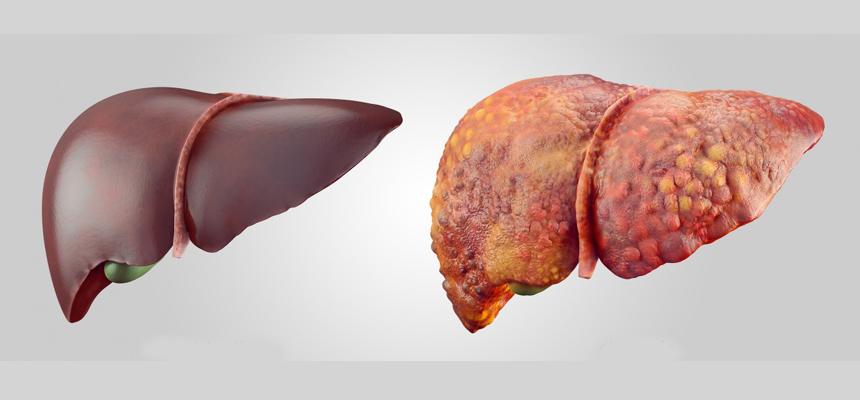 Shedding Light on Fatty Liver