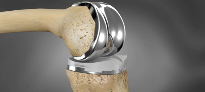 MTaI Statement on the Need to Revisit Price Cap on Knee Implants