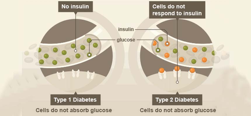 Diagnosing type 1 and type 2 diabetes