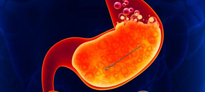 Metal found inside a man