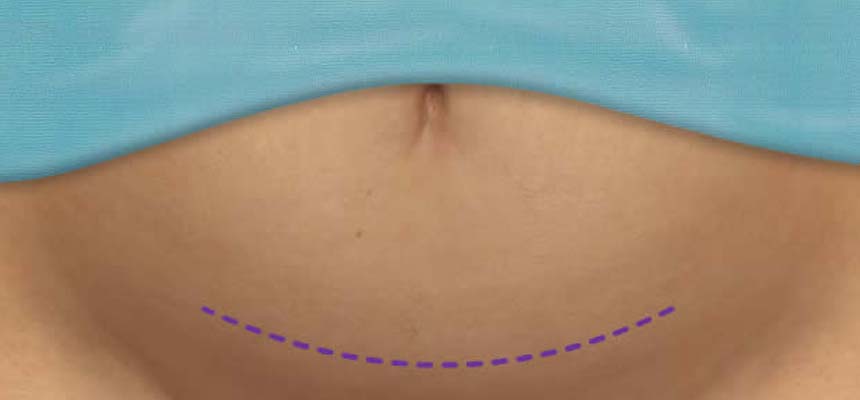 Best approach to cut weight post C-section Birth