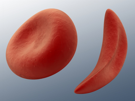 Sickle Cell Disease awareness on the World Sickle Cell Day