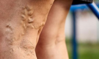 VARICOSE VEINS A GUIDE TO UNDERSTANDING AND PREVENTING THEM