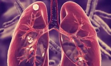 STAY SAFE FROM THE FATAL TUBERCULOSIS