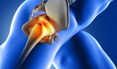 REALITY CHECK ON KNEE REPLACEMENT SURGERY