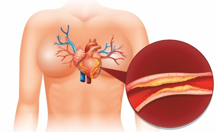 CORONARY ARTERY DISEASE