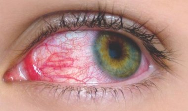 Pink eye (Conjunctivitis)
