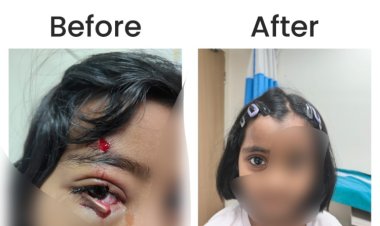 KIMS Hospitals Restores Vision Function in Six-Year-Old with Complex Eyelid Reconstruction
